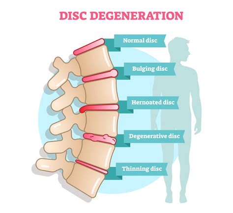 What is the maximum disability rating for degenerative disc disease - ٢٨ جمادى الأولى ١٤٢٩ هـ ... To be rated on incapacitating episodes you have to be SC for IVDS Intervertrebal Disk Syndrome. General Rating Formula for Diseases and Injuries ...